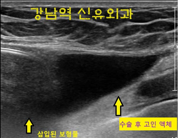 왜 물방울보형물을 쓰는 병원들의 숫자가 점차 줄어들까요? 