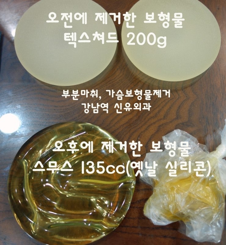 오전, 오후에 제거한 가슴보형물 ; 부분마취 겨절로 제거한 오전 환자분 & 20년된 실리콘백파열로 부분마취로 유륜절개 제거한 오후 환자분