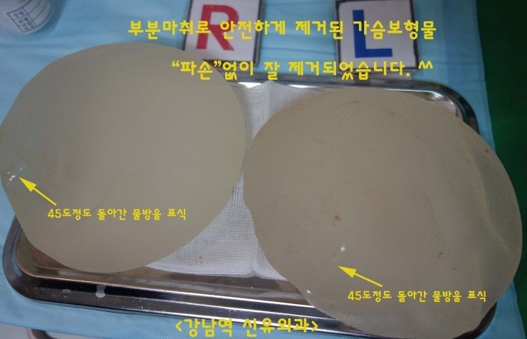 가슴보형물제거수술시 피막제거는 루틴으로 시행되어서는 안 됩니다. 