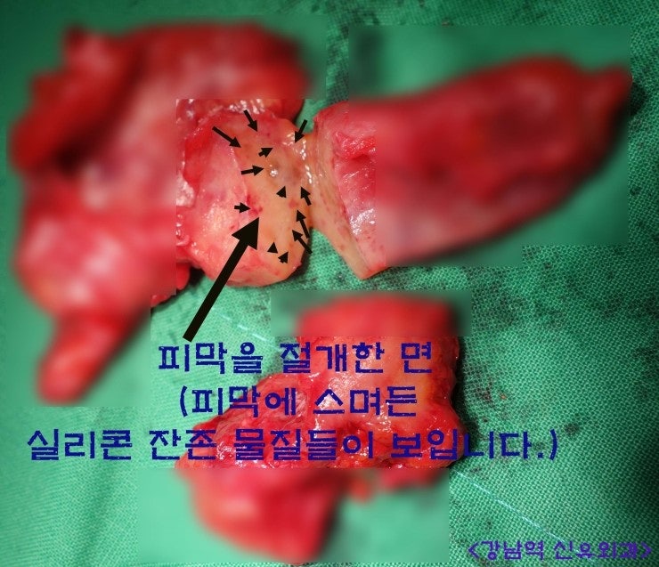 옛날 실리콘 "피막외 파손"으로 퍼져버린 실리콘을 포함하여 피막을 몽땅 제거한 미국에서 오신 환자분의 증례(파손제거시 왜 겨절이 위험할 수 있는 지...)