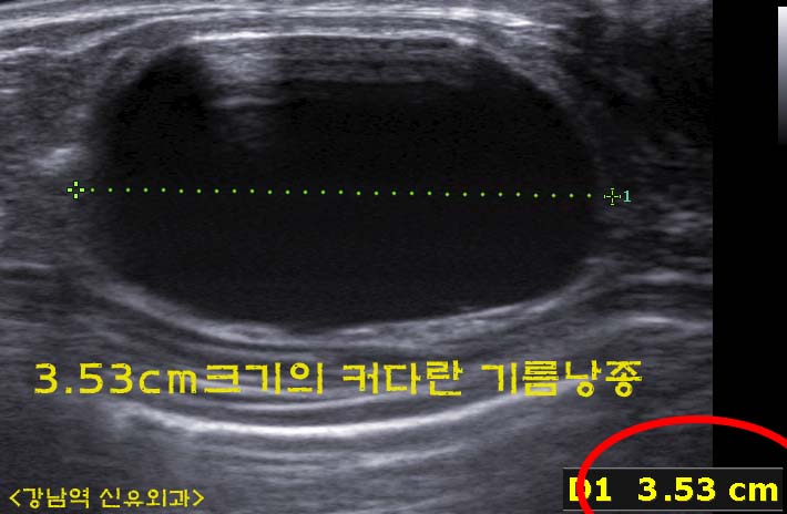 지방괴사로 인한 3.5cm 거대기름낭종: 가슴지방이식부작용 치료 후기. 