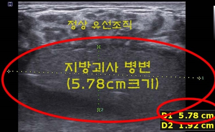 가슴지방이식부작용으로 피부가 썩어가던 분 ㅠㅠ 
