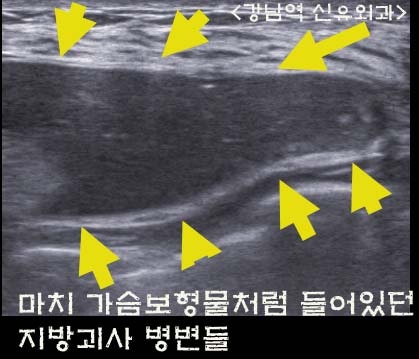 가슴지방이식괴사가 마치 보형물처럼 피막 방을 만들었던 증례