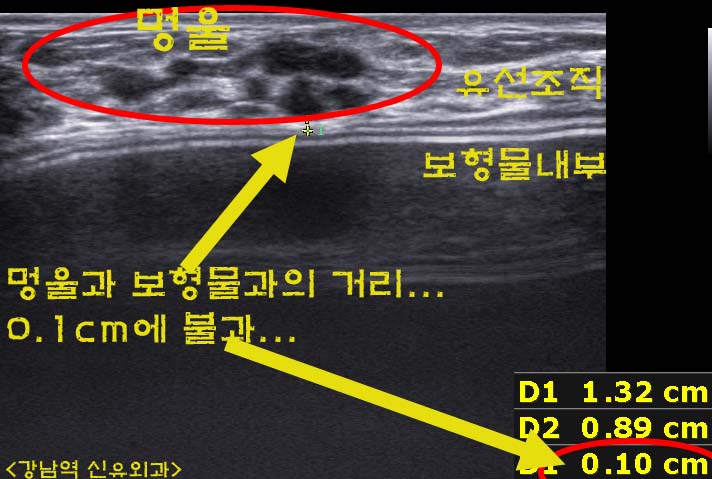 가슴성형후 보형물맘모톰수술후기.