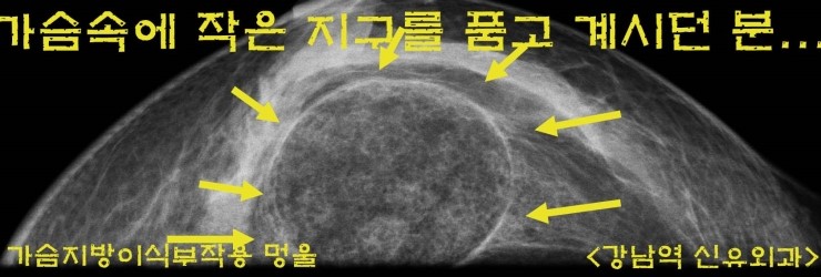 가슴지방이식부작용치료후기