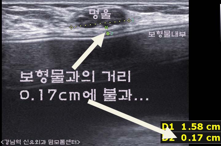 가슴성형후맘모톰(보형물맘모톰)수술전후사진.