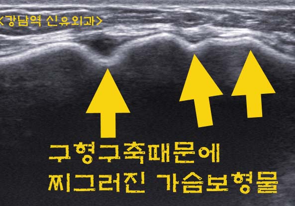 가슴성형수술후 구형구축 여부를 검사를 통해 객관적으로 확인 받으신 분