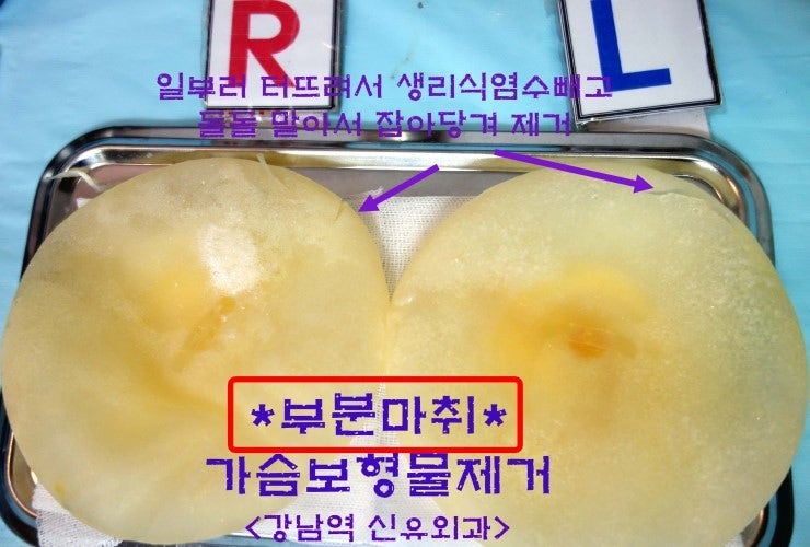 가슴보형물제거수술후기 : 오전 vs 오후 (모두 부분마취만!)