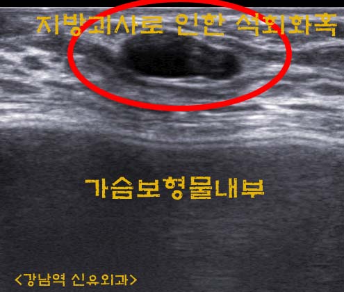 물방울가슴보형물파손없이 제거한 자가지방이식가슴성형수술부작용치료후기.