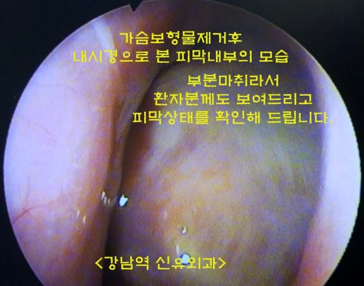 가슴보형물제거수술 (부분마취) 캡쳐한 사진들입니다. 
