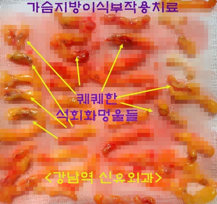 가슴지방이식석회화부작용치료수술후기. 고생 많이 하셨으나 감사히도 다 잘 나아주신 분.