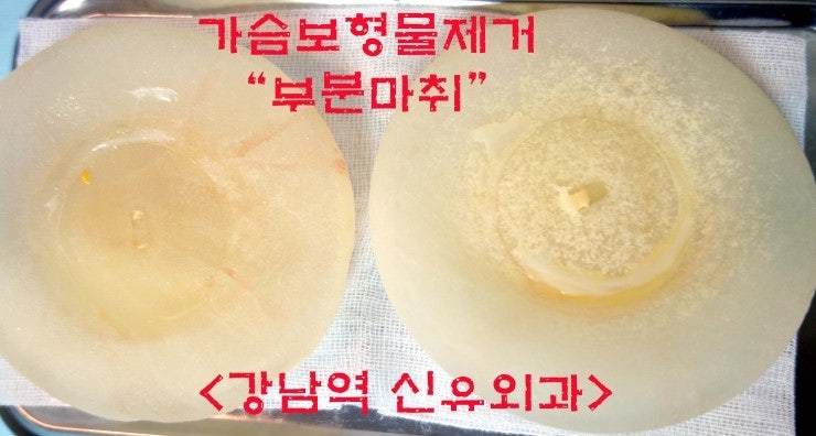 가슴보형물제거수술후기. 유륜주위 1.5cm크기만 구멍내서 생리식염수백 터뜨려서 돌돌 말아서 뽑음. 모두 부분마취로.