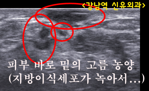 가슴자가지방이식성형수술부작용치료후기 : 고름농양이 가슴 한 가운데 피부를 뚫고 쏟아져 나왔던 환자분.