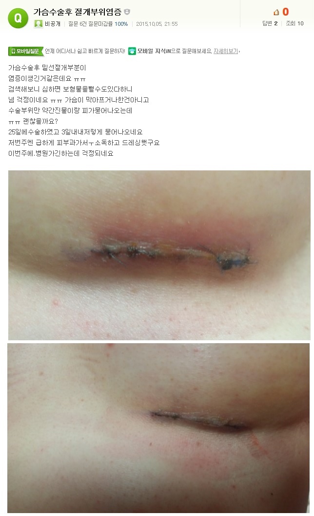 가슴수술후 절개부위염증 : 네이버지식인 부작용답변글.