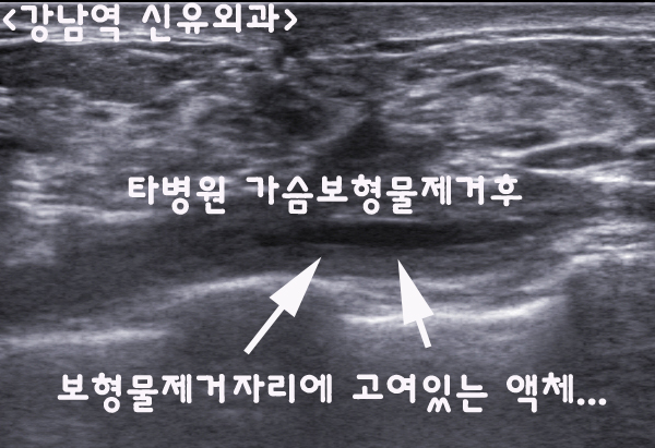 가슴보형물제거수술후기. 한쪽만. 역시 부분마취로만.
