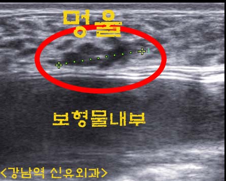 가슴성형후 보형물맘모톰수술후기 ; 보형물과 멍울이 단지 0.7mm 떨어졌던 분(0.7cm이 아니라...). 