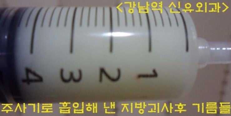 가슴지방이식부작용치료로 주사기로 흡입하니 끈적한 기름들이 나왔던 분.