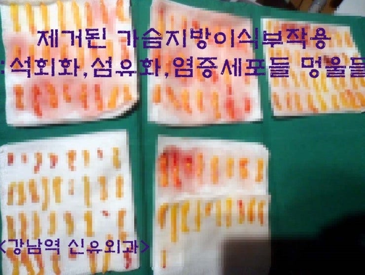 원래 병원에서 캐뉼라(?)로 쑤신 후 퍼져서 더 악화되어 오신 가슴지방이식부작용환자분. 