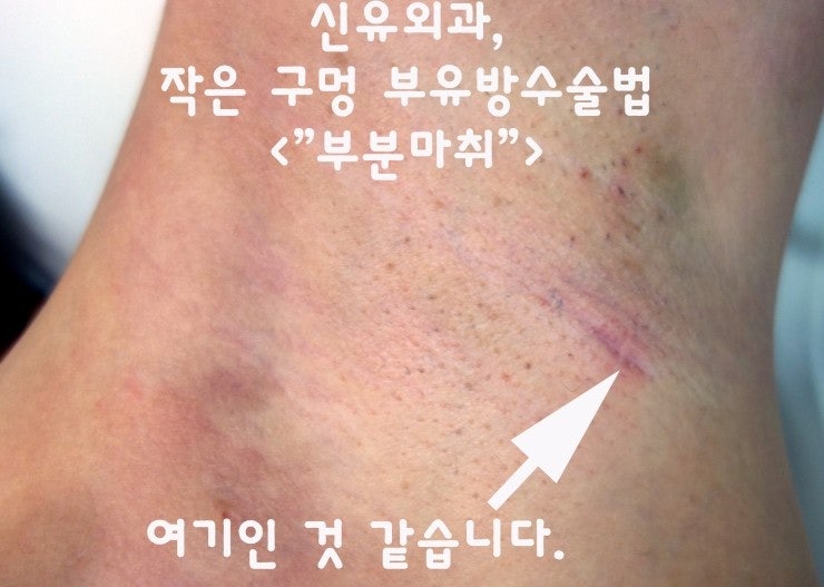 부유방수술후기(작은 구멍 수술법) :정말 흉터 찾기 어려웠던 분.
