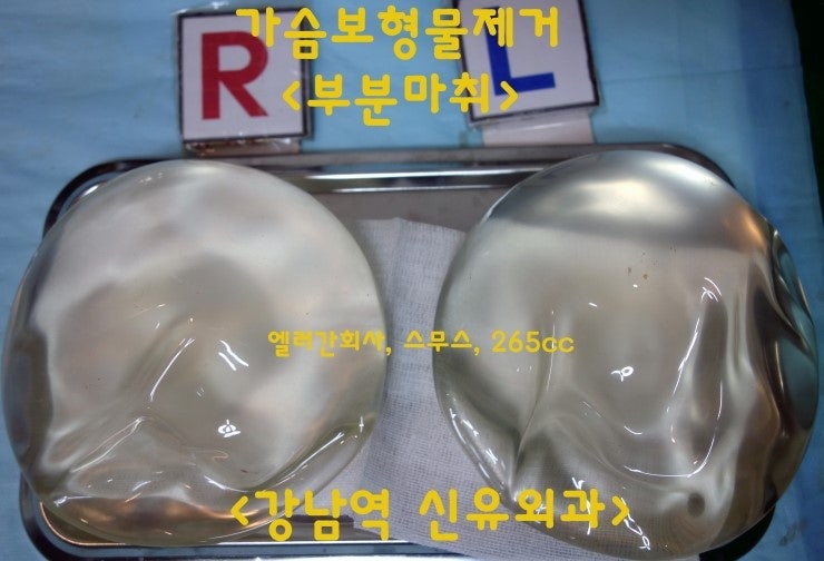 가슴보형물제거수술후기, 부분마취, 엘러간 스무스 265cc.