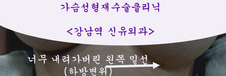 겨절로 물방울가슴성형재수술을 한 증례, 내시경으로 밑선 보강하는 봉합도 시행