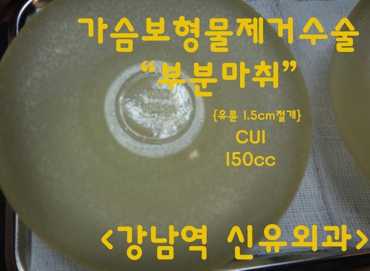가슴보형물제거수술후기, 부분마취, CUI 150cc ☆수술과정 설명☆
