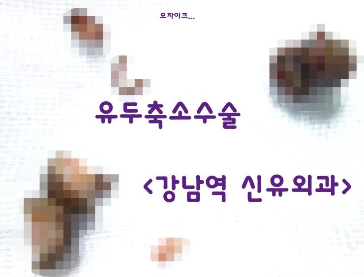 여성유두축소수술후기 (몽고메리결절제거와 함께) --> 높이까지도!!! 낮추었습니다. 게다가 수유가능!!! ^^::