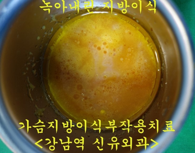 가슴지방이식부작용치료수술후기 : 2달 후에 이식지방이 터져서 급성 염증 생긴 분.