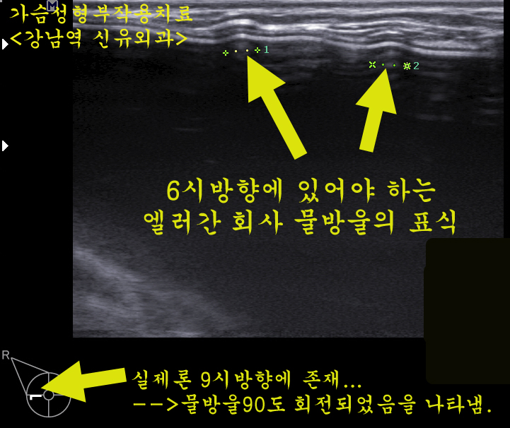 물방울보형물이 정확히 90도 돌아간 경우. 엘러간 270cc, 밑선절개. 