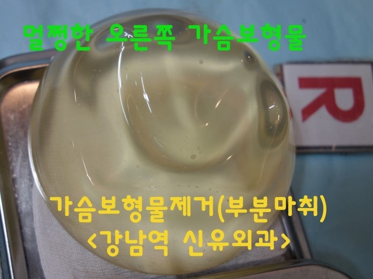 가슴보형물"제거"와 "교체"수술을 동시에 받으신 후기 (부분마취)