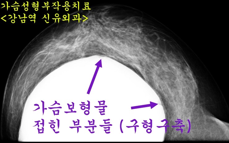 #1.가슴성형후 만져지는 멍울-->구형구축으로 인해 보형물접힌 것 #2.물방울보형물이 돌아가는 이유와 대처