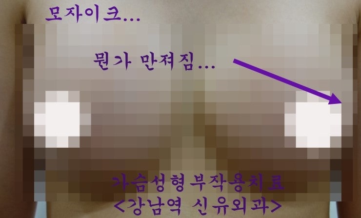 가슴성형수술후 만져지는 멍울의 정체......는 보형물접힘