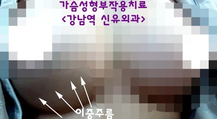 물방울가슴성형후 이중주름(더블라인)잡혀서 오신 분.(타병원)