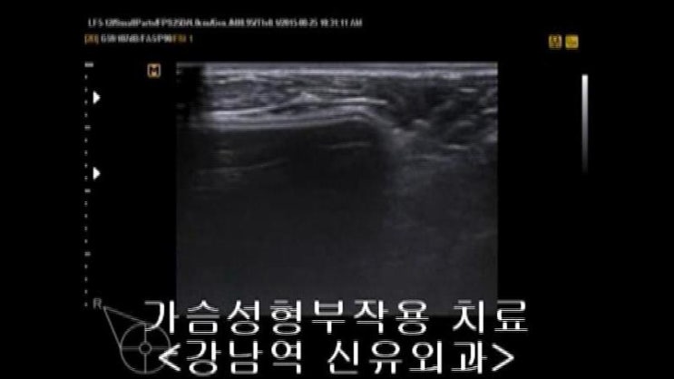 물방울보형물과 라운드텍스쳐드보형물이 유착되지 않고 움직이고 돌아다니는 경우