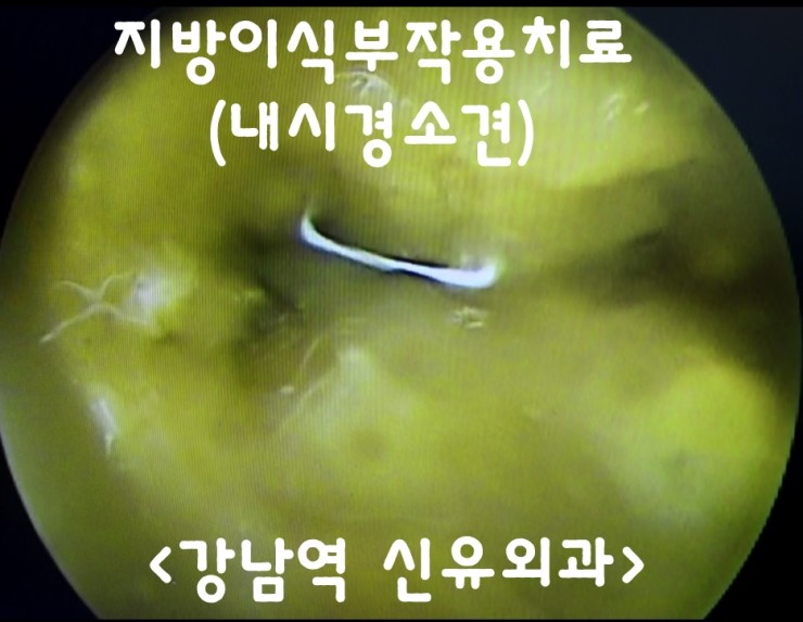 가슴지방이식부작용으로 3~4년 고생하시다 제거수술받으신 분의 후기