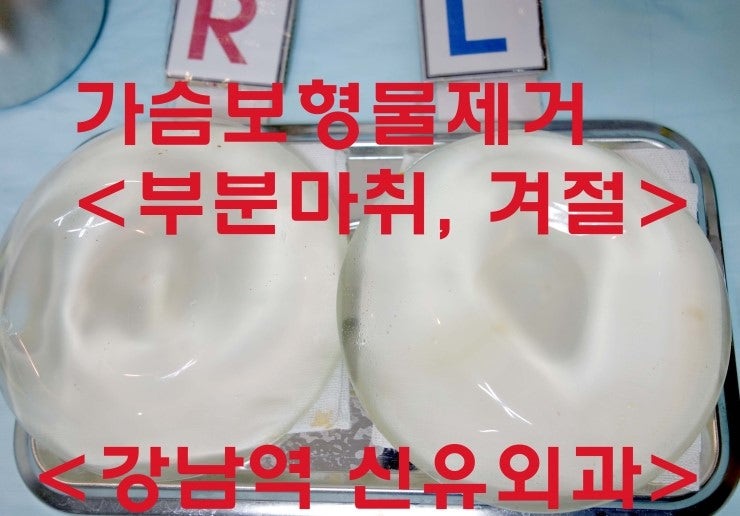 겨드랑이절개도 <부분마취>로 "가슴보형물제거"받으신 분의 수술후기
