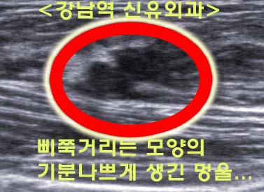 하나의 구멍으로 세 개의 가슴멍울을 제거한 맘모톰 시술 <강남역 신유외과>