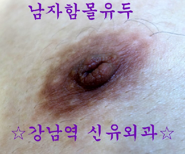 ☆남자함몰유두교정수술후기☆전후사진☆