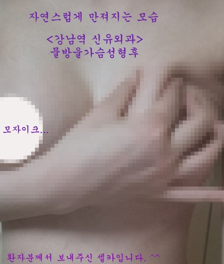 물방울가슴성형수술후기 (자가지방이식부작용치료후, 강남역 신유외과) 전후사진과 함께
