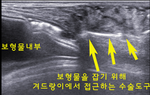 가슴보형물제거, 강남역신유외과홈페이지 올릴 내용입니다.