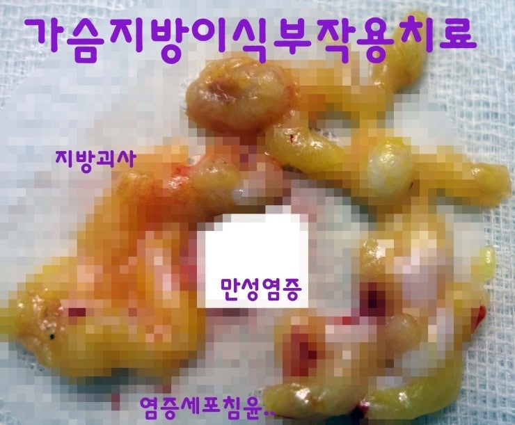지방괴사, 이물질반응, 만성염증, 섬유선종 등이 가슴지방이식부작용치료하여 나온 분의 수술후기.