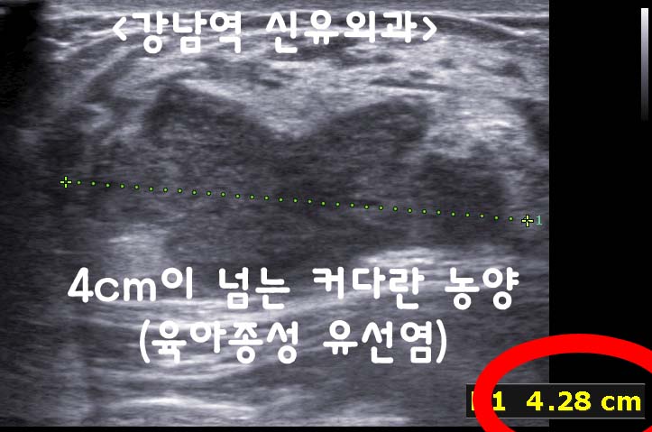 육아종성 유선염의 맘모톰수술후기
