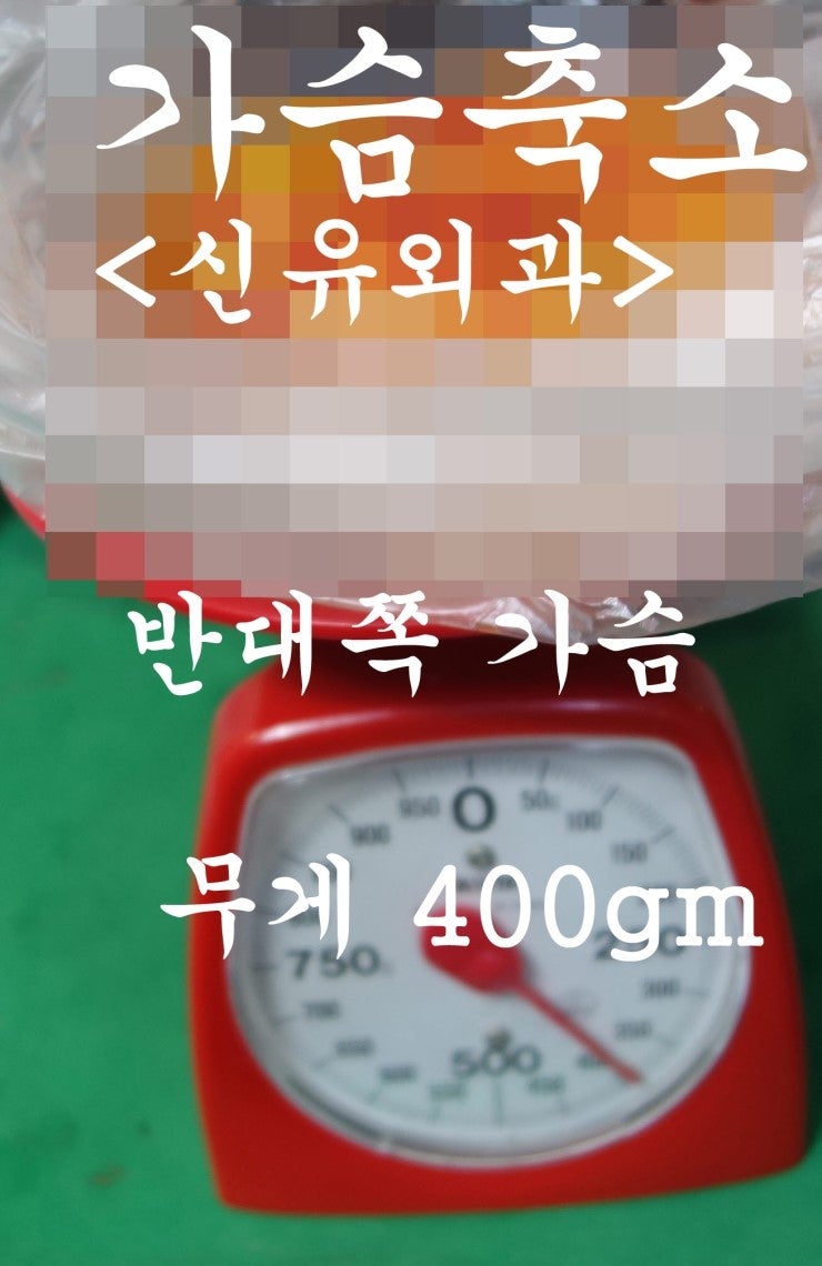 가슴축소수술후기 : 강남역 신유외과