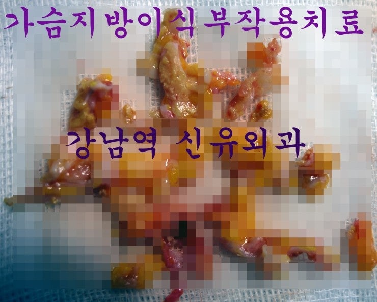 대구에서 오신 분의 가슴지방이식부작용치료수술후기. [염증성침윤, 석회화, 섬유화 조직검사결과]