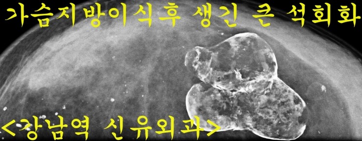 2008년 줄기세포로 자가지방이식을 가슴에 하신 분 부작용치료후기.