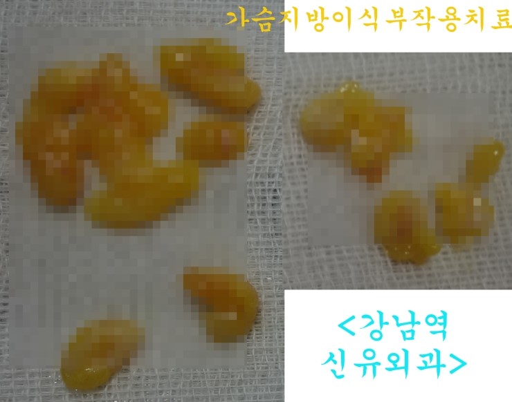 가슴성형수술하기 전, 가슴지방이식부작용치료를 먼저 받으신 분의 맘모톰수술후기