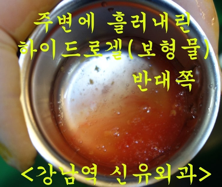 일본에서 하이드로겔가슴성형수술을 받으신 후 파손되어 제거와 거상(가슴리프팅)을 동시에 부분마취로 수술받으신 후기.