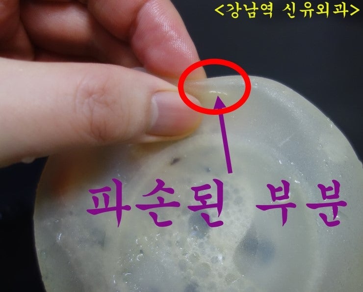 60세 넘으신 분 가슴보형물파손제거수술도 부분마취만으로 15분만에 양쪽 다 뺀 후기