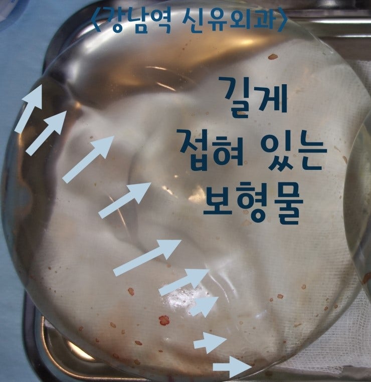 가슴보형물제거수술후기. :스무스 250cc가 길게 접혀 있던 분. 