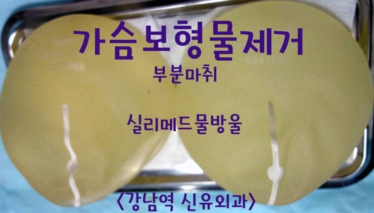 실리메드물방울 270cc 가슴보형물 부분마취 제거수술후기